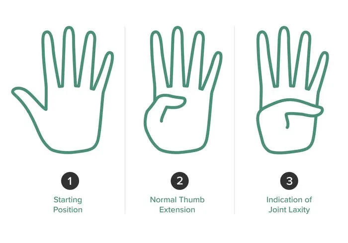 Three hand illustrations show thumb positions: 1) Starting Position, 2) Normal Thumb Extension, 3) Indication of Joint Laxity